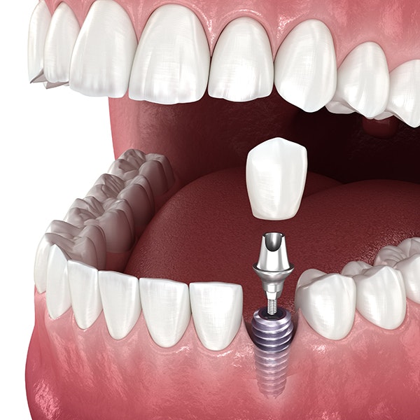 Implant-supported crown