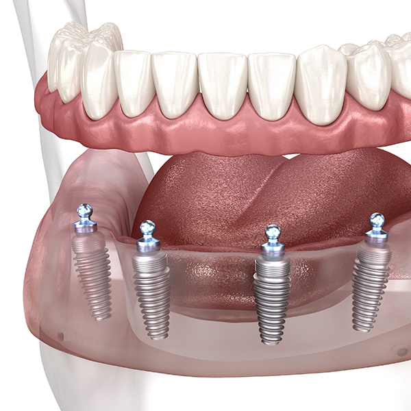 Abutments being placed on implants