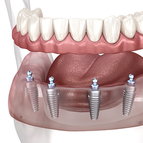 Abutments being placed on implants