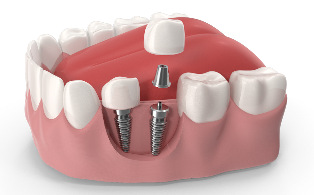 A 3-D model demonstrating how a metal implant post looks in comparison to a tooth root.
