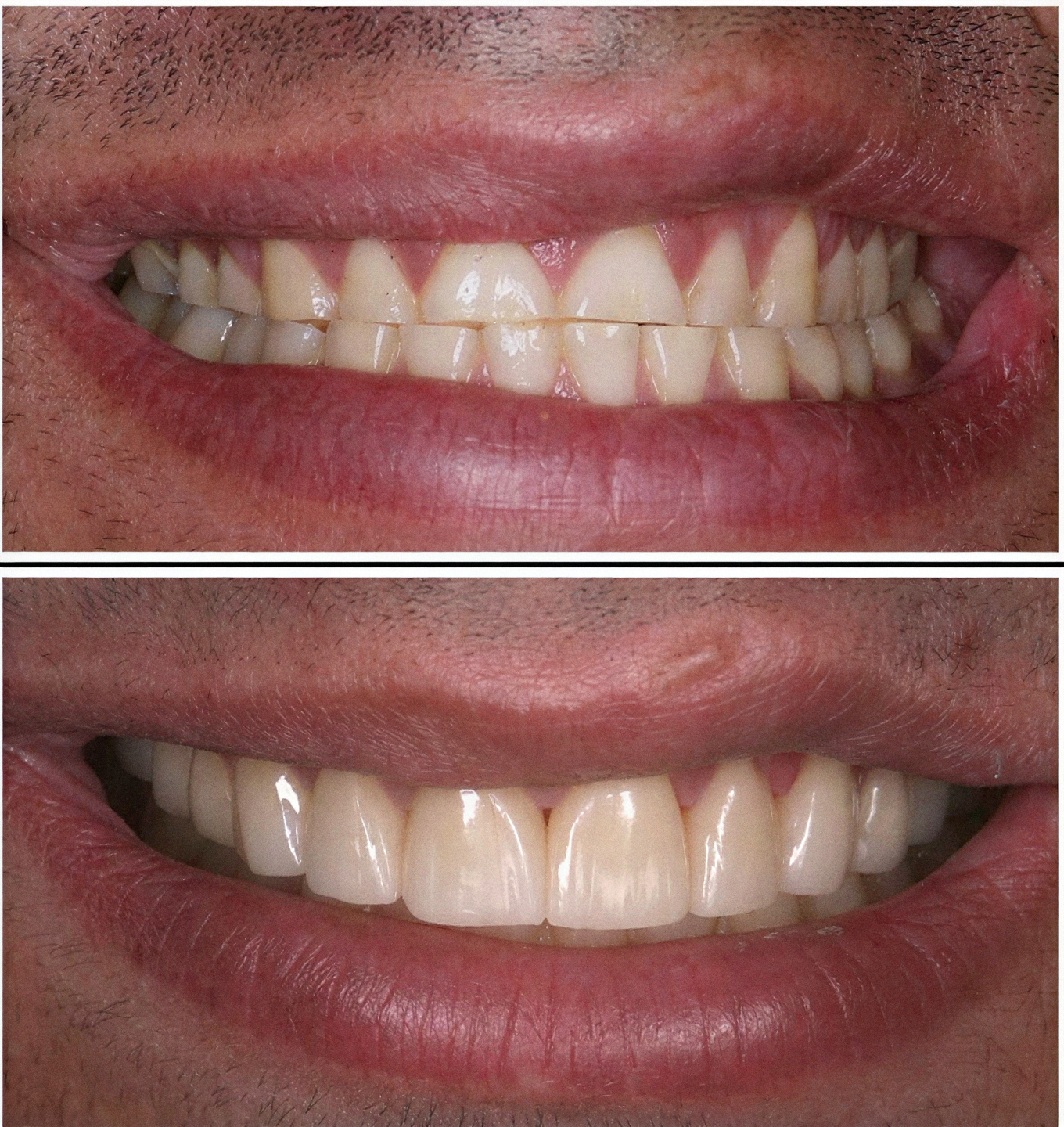 Smile makeover patient of Dr. James M. Stein, DMD — Boston, MA