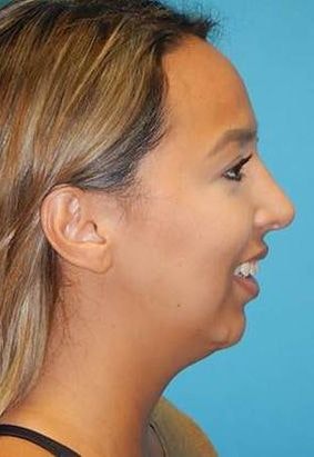 After Nose Surgery
