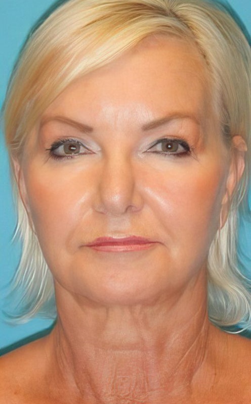 Before mini facelift