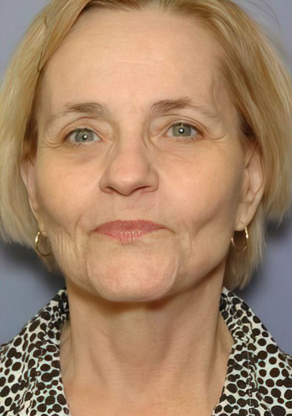 After Face & Neck Lift