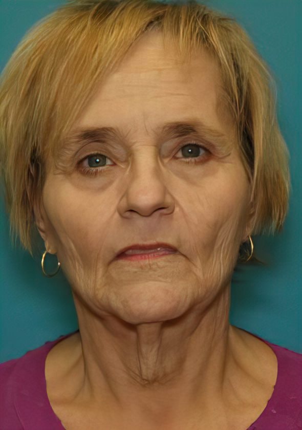 Before Face & Neck Lift