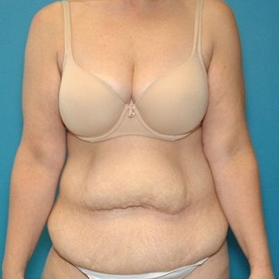 Before Tummy Tuck