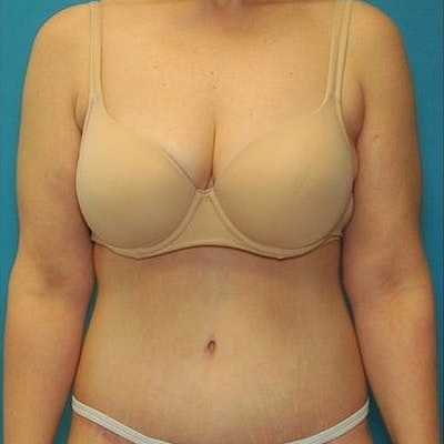 After Tummy Tuck