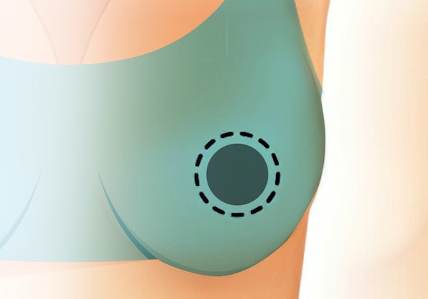 Illustration of a donut incision
