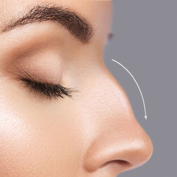 nose with a bump in it