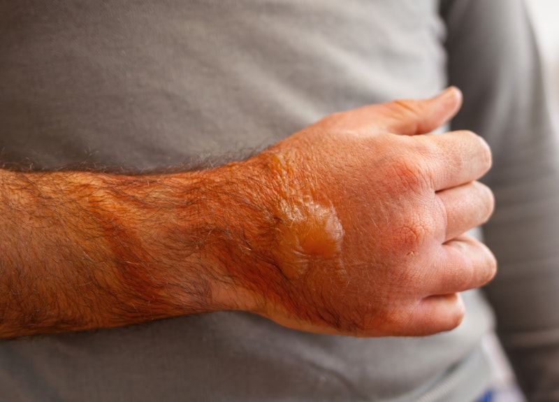 burnt arm