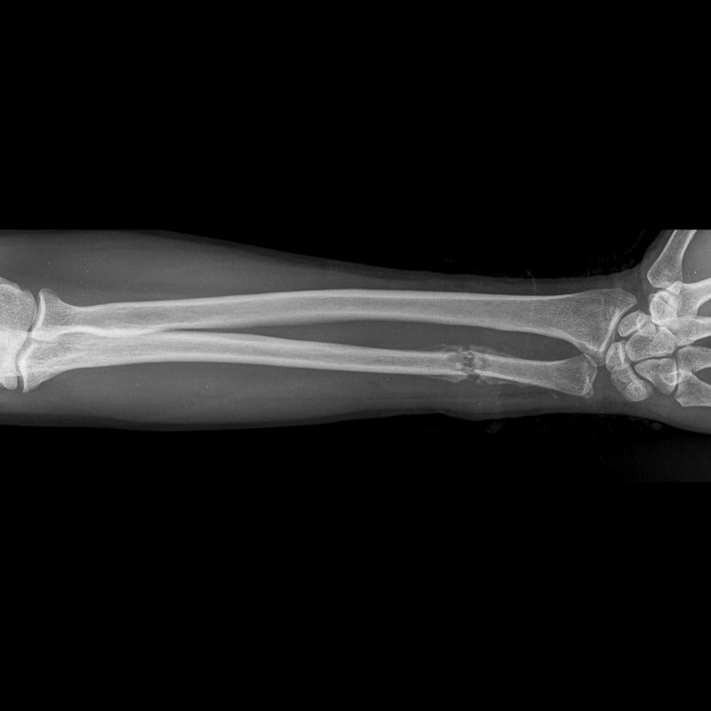 X-ray of a forearm fracture