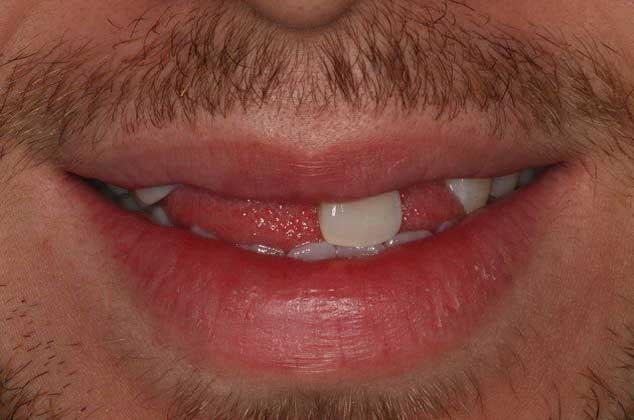 before dental implants