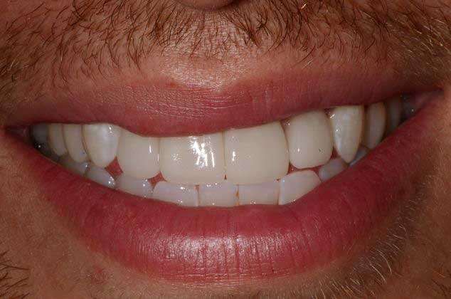after dental implants