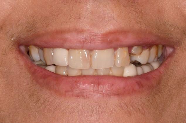 Before Dental Implant