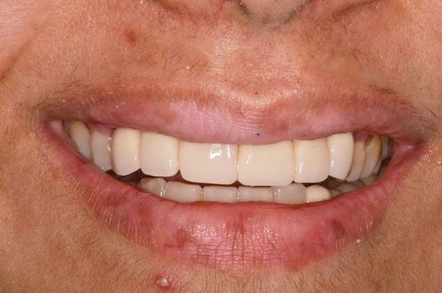 After Dental Implant