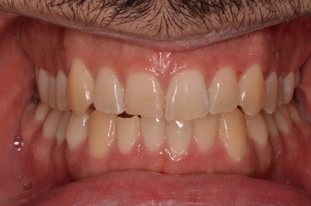 Dr. Podilsky's Patient After Invisalign