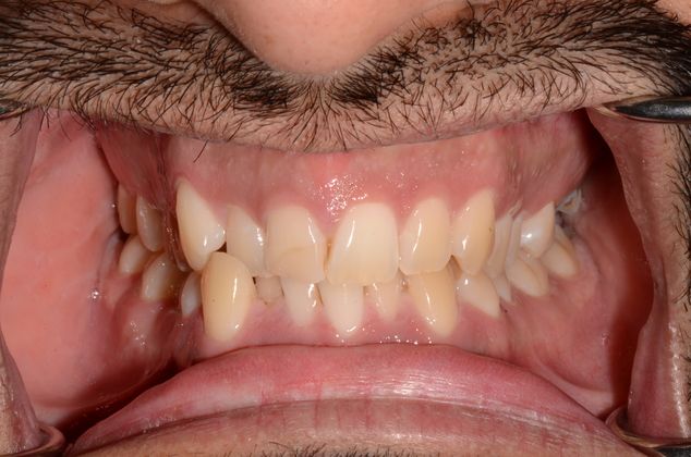 Dr. Podilsky's Patient Before Invisalign