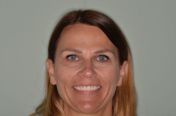 Smiles First Corporation Patient After Veneers