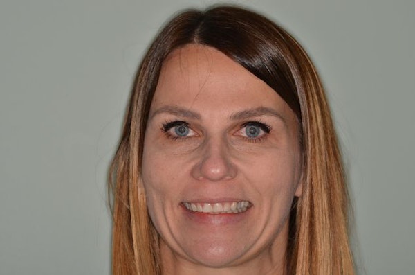 Smiles First Corporation Patient Before Veneers