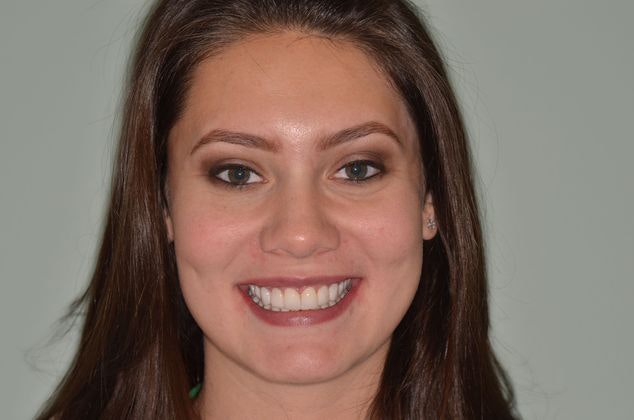 After Composite Bonding