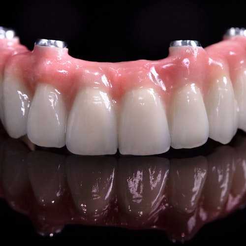 implant dentures