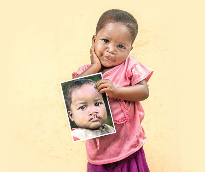 child before and after cleft palette surgery