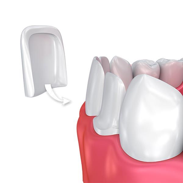 veneers