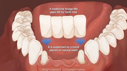 Dental Bridges Kansas City, MO - Tooth Bridge - John P. Goodman DDS