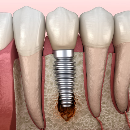 Dental Implant Placement