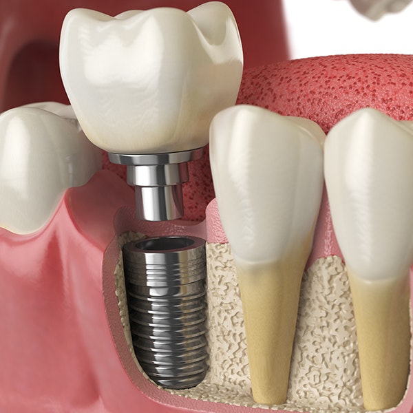dental implant