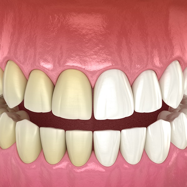 before and after teeth whitening