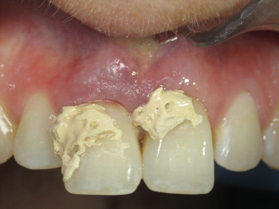 BEFORE DENTAL IMPLANTS