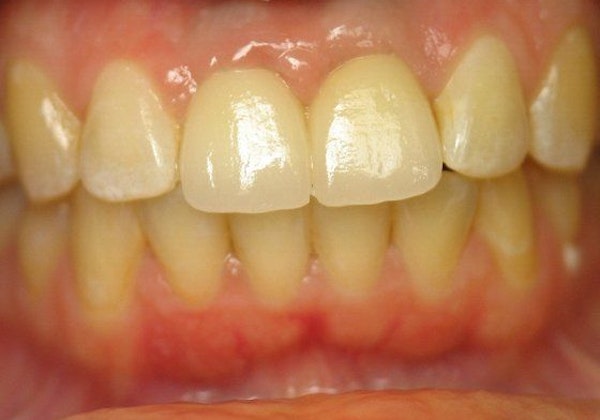 AFTER DENTAL IMPLANTS