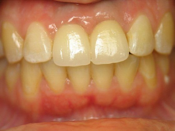 AFTER DENTAL IMPLANTS