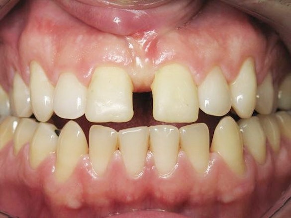 Dr. John Goodman's patient Before Crown Placement