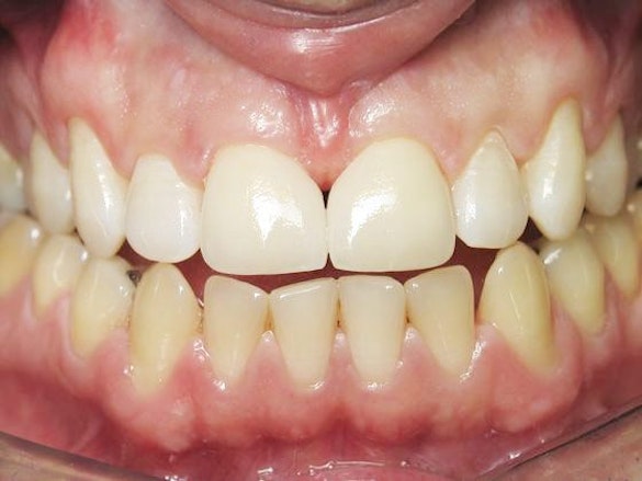 Dr. John Goodman's Patient After Crown Placement