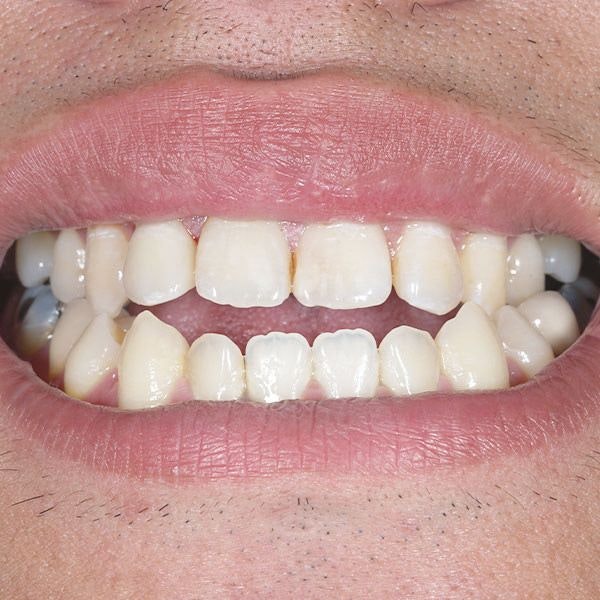 close up of an open bite