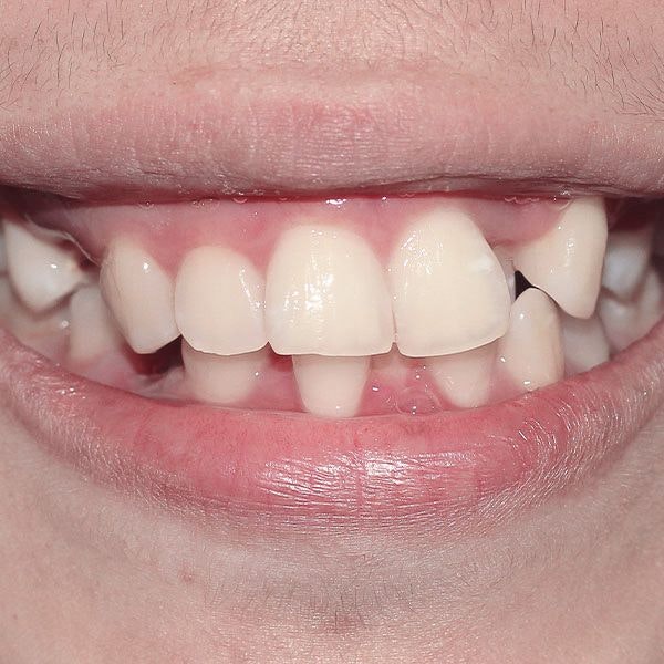 closeup of a crossbite