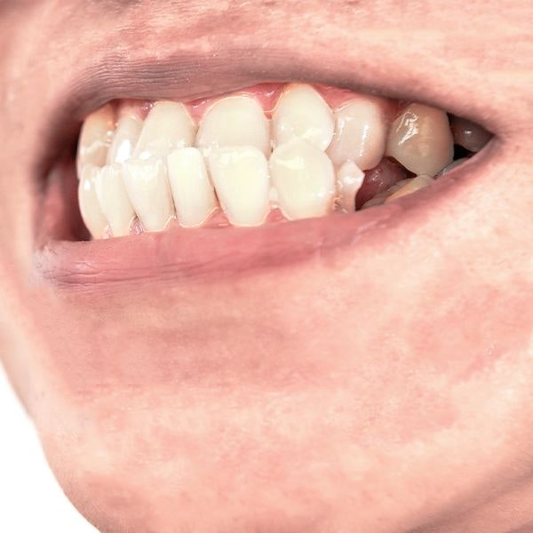 a closeup of an underbite