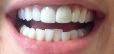 Dr. John Goodman's patient before orthodontics