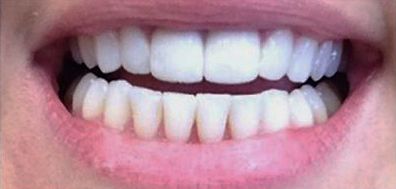 Dr. John Goodman's patient after orthodontics