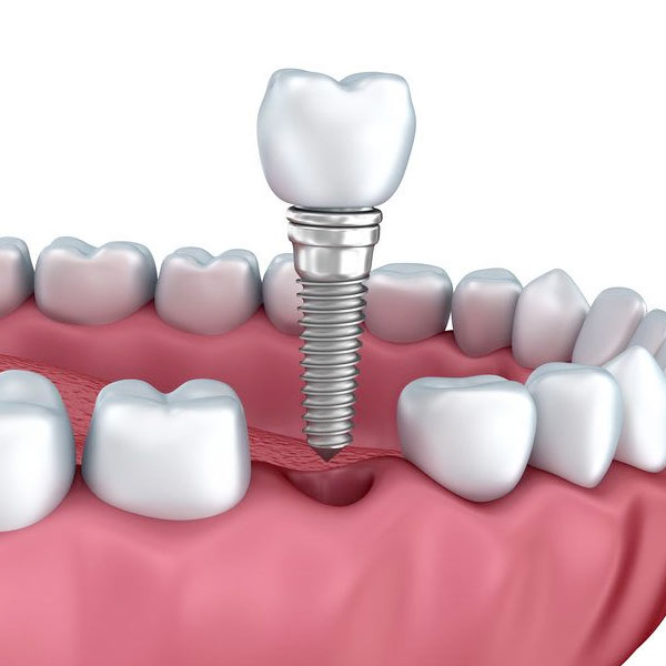 Implant-supported crown