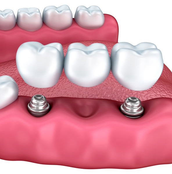 Implant-supported bridge