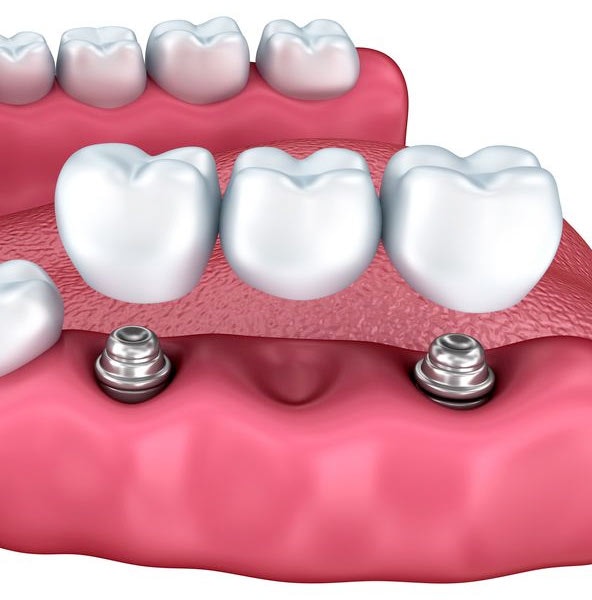 Implant-supported bridge