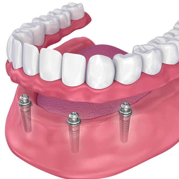 Implant-supported denture