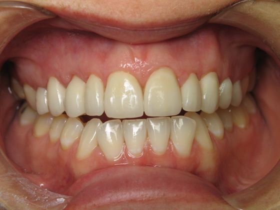 Dr. John Goodman's patient after veneers