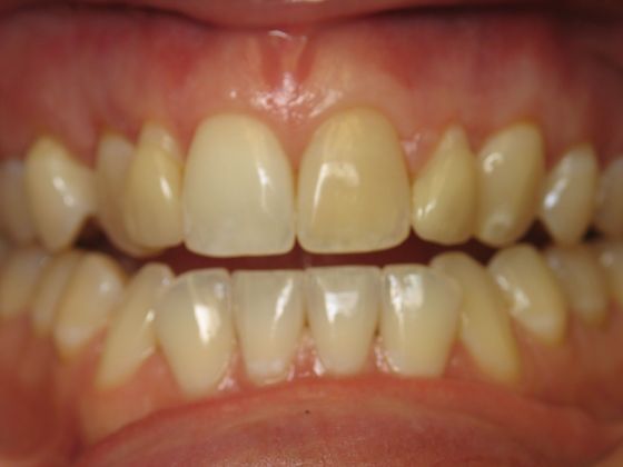 Dr. John Goodman's patient before veneers