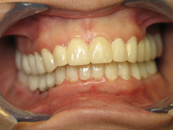 After a Smile Makeover