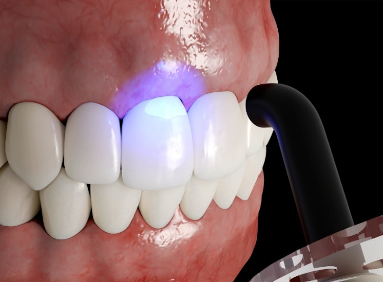 dental bonding procedure