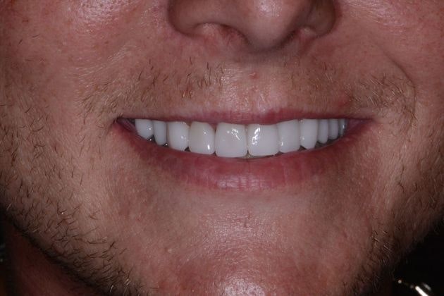 patient after smile makeover in kansas city